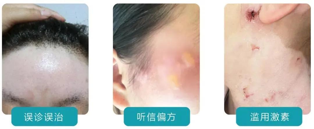 白癜风前沿资讯大揭秘，最新治疗与科研进展探索
