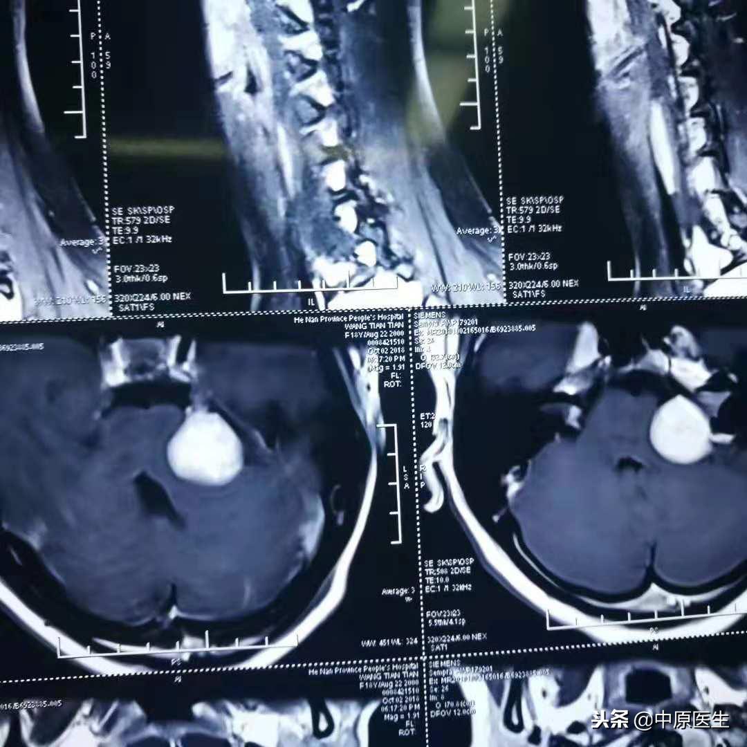 神经纤维瘤最新资讯更新🌟