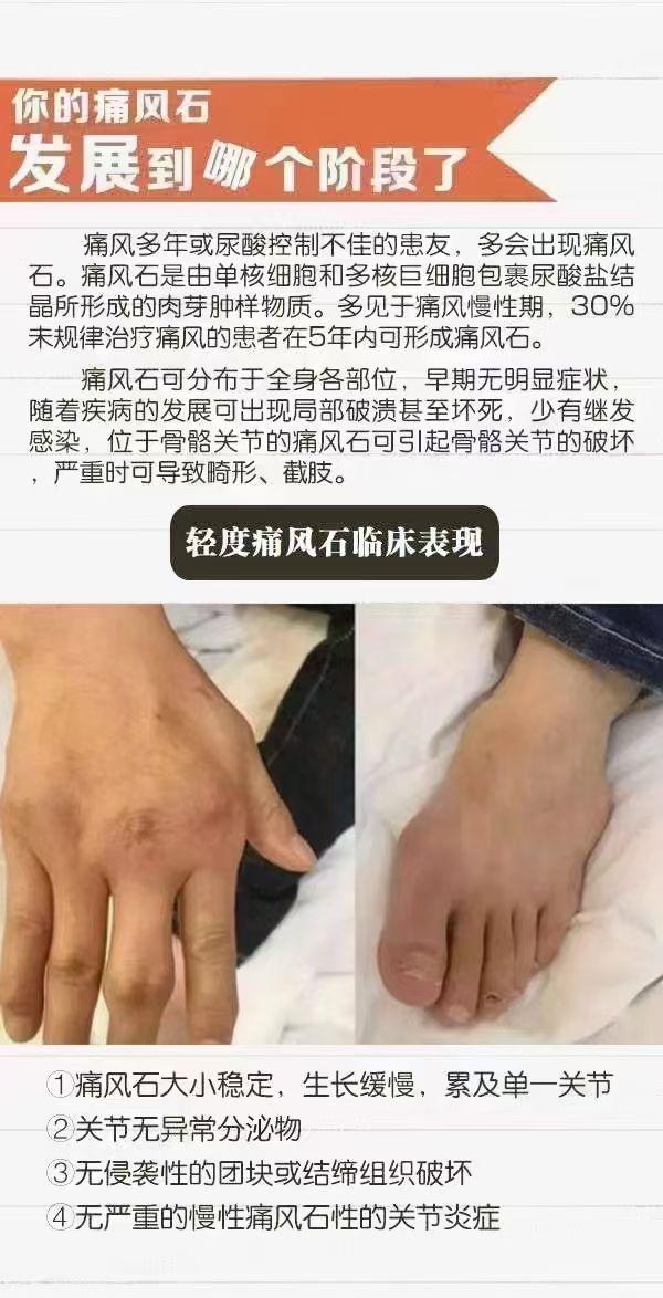 最新痛风治疗方法论述，探索未来的治疗策略（2025年）