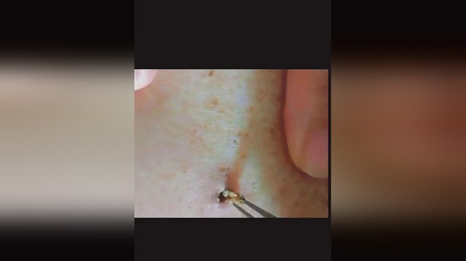 告别草莓鼻，打造无瑕肌肤，最新挤黑头技巧分享！