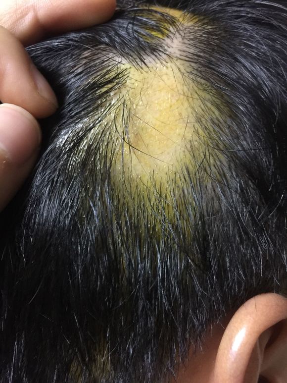 斑秃现象最新关注，地位与影响探究